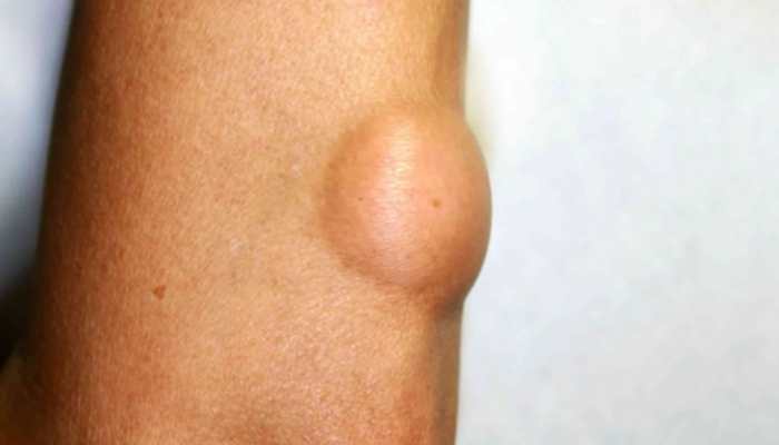 Lumps In Neck, Armpits Might Be A Sign Of Lymphatic Cancer: Study