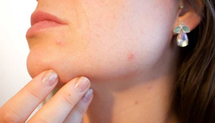 Fertility Treatment Causing Acne, Other Skin Issues? Check Expert&#039;s Advice