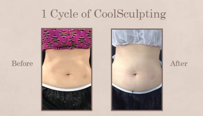 CoolSculpting: Your Comprehensive Q&amp;A Guide To Non-Surgical Fat Reduction