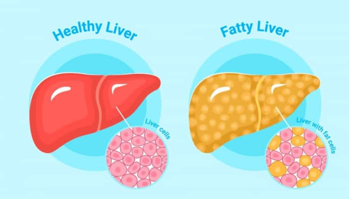 Sleep-Liver Connection: How Sleep Apnea Impacts Liver Health? Expert Shares Ways For Effective Treatment