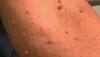 Neurofibromatosis