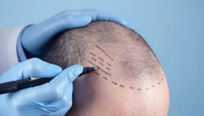 15 Best Hair Transplants Packages In Istanbul And Turkey