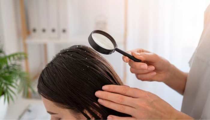 Dandruff Trouble In Winter: How To Keep Scalp Clean, Remedies To Follow