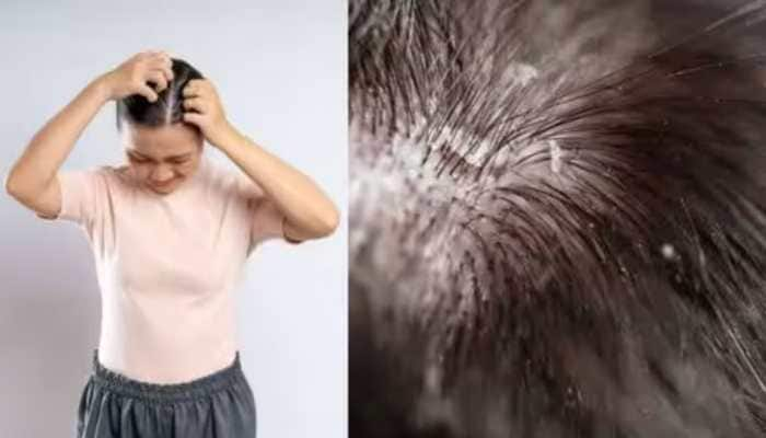 10 Homemade Remedies To Prevent Dry Scalp