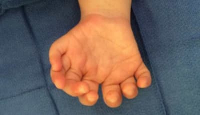 Rare Disorder Behind Extra Fingers And Toes: Study