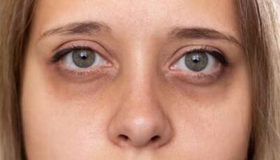 Dark Circles Under The Eyes: 10 Ways To Reduce Under-Eye Shadow 