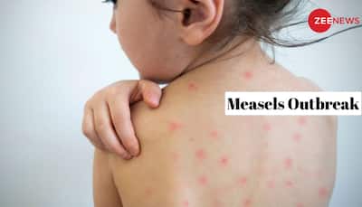 Measles Outbreak: Understanding Symptoms, Prevention And Treatment