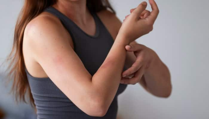 Feeling A Little Itchy? 5 Ways In Which Shingles Can Affect Your Body Beyond Skin