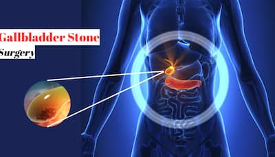 Managing Gallstone Symptoms: What You Need to Know About Cholecystectomy- Expert Shares
