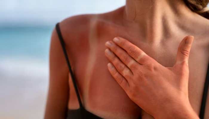 How To Get Rid Of Sunburn