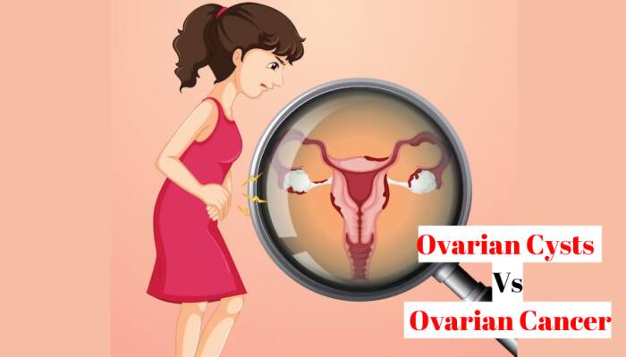 Difference Between Ovarian Cyst And Ovarian Cancer? All You Need to Know