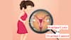 Difference Between Ovarian Cyst And Ovarian Cancer? All You Need to Know