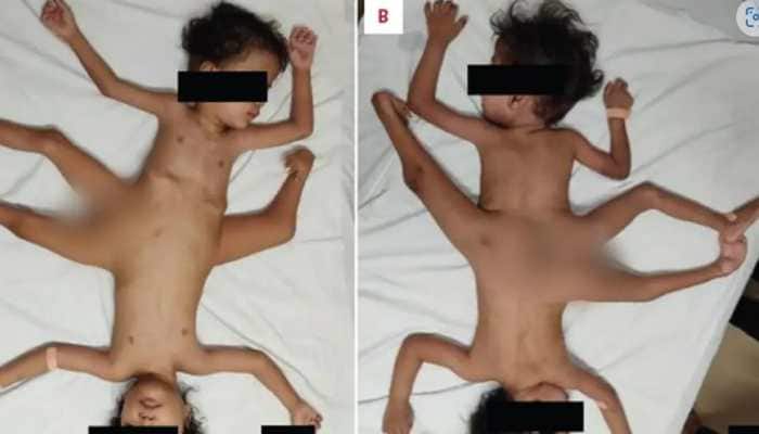 Extremely Rare Conjoined Twins Born In Indonesia Have 4 Arms, 3 Legs