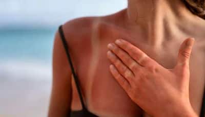 How To Get Rid Of Sunburn? Expert Shares Tips