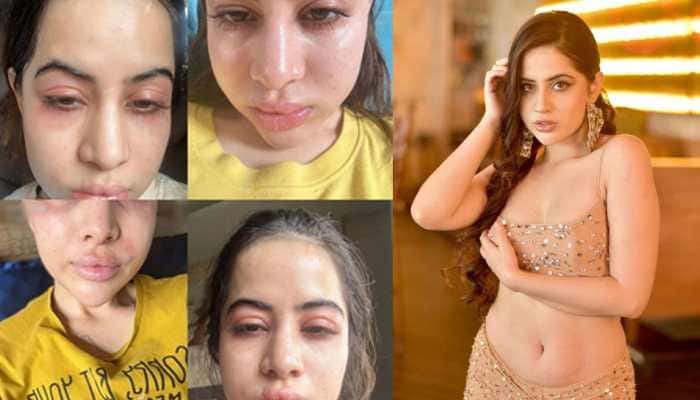 Uorfi Javed Admits Using Fillers And Botox Since She Was 18, Clarifies &#039;Face Swollen Due To Allergies&#039; 