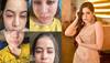 Uorfi Javed Admits Using Fillers And Botox Since She Was 18, Clarifies 'Face Swollen Due To Allergies' 