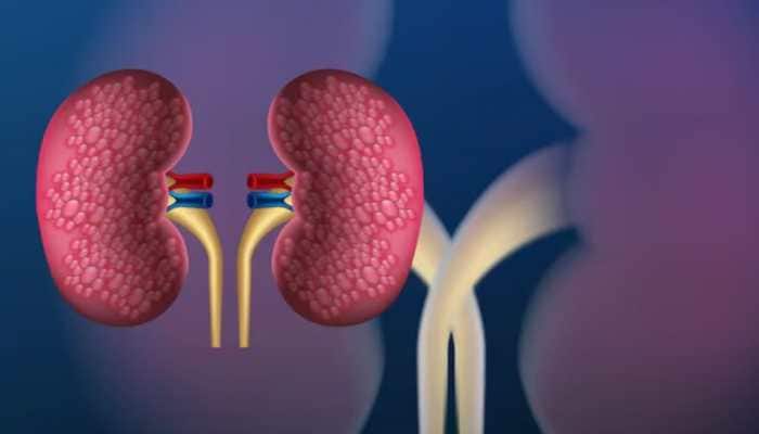 Therapies For Kidney Cancer: What You Need To Know
