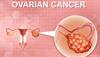 Ovarian cancer