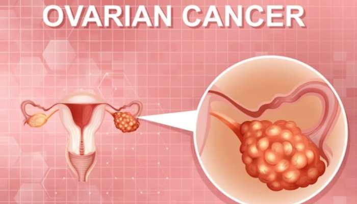 Demystifying Ovarian Cancer: Causes, Symptoms, Treatment, And Prevention