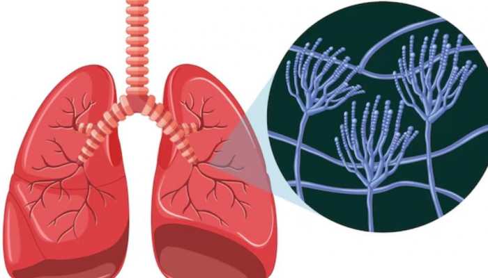 Breakthrough In Lung Cancer Treatment, Study Finds
