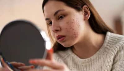 Unmasking The Link: Stress And Skin Issues 
