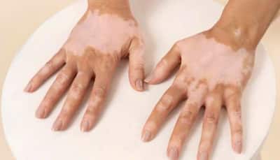 World Vitiligo Day: Special Workshop Raises Awareness About Skin Disease