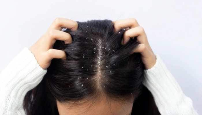 Breaking Myths: Does Applying Oil Reduces Dandruff 