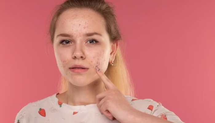 Clearing The Way: Tips For Managing Forehead Acne In Teens And Young Adults