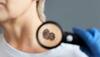 Melanoma