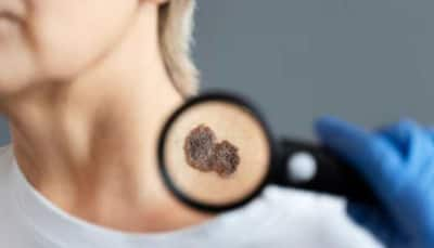 Unveiling Melanoma: Understanding the Hidden Truths of Skin Cancer