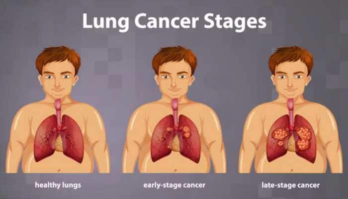 Spotting Lung Cancer: Symptoms, Treatment, And Prevention