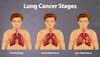 Spotting Lung Cancer: Symptoms, Treatment, And Prevention