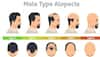 Battle Of The Bald: Unraveling The Male vs Female Differences In Alopecia