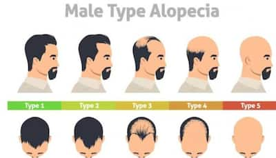 Battle Of The Bald: Unraveling The Male vs Female Differences In Alopecia