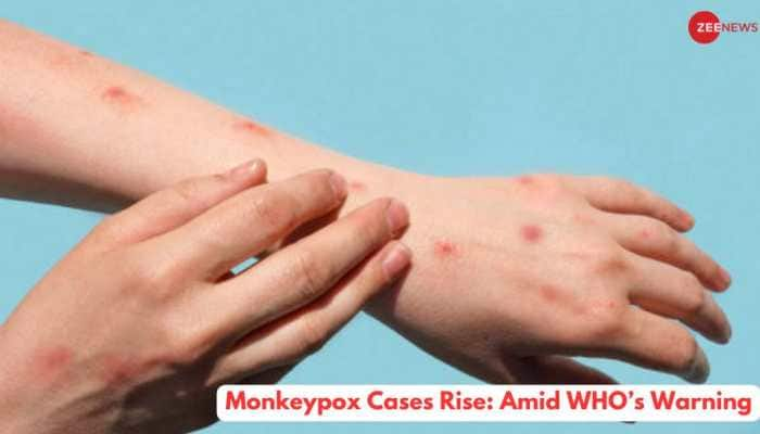 Monkeypox Cases Rise: Amid WHO’s Warning, Check Expert’s Take On How It Spreads, Prevention And More