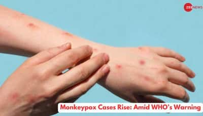 Monkeypox Cases Rise: Amid WHO’s Warning, Check Expert’s Take On How It Spreads, Prevention And More