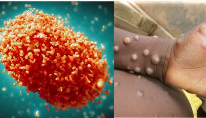 Centre Heightens Mpox Vigilance At Airports, Designates 3 Nodal Hospitals