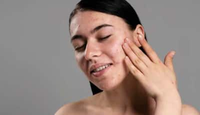 Tips For Managing Oily Skin This Monsoon Season