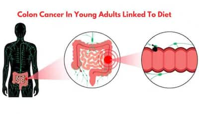 New Study Reveals Diet As A Key Risk Factor For Colon Cancer In Young Adults