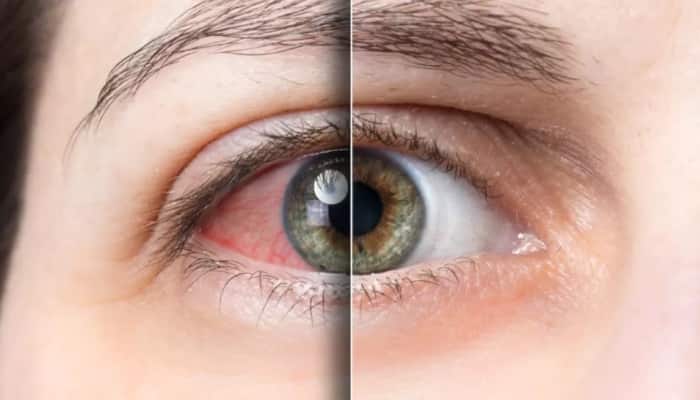 7 Tips to Prevent Eye Flu During Monsoon Season