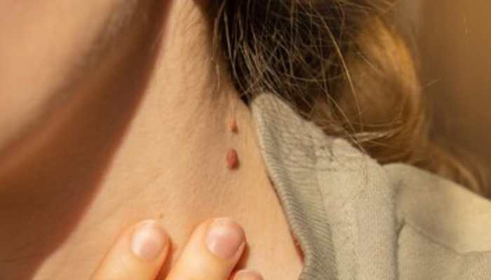 Can Birthmarks Be Inherited? A Look At Genetic Factors