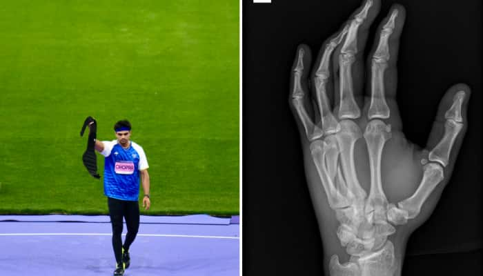 Neeraj Chopra&#039;s Shocking Injury News Revealed: Javelin Star Competed With Broken Hand In Diamond League Final 2024