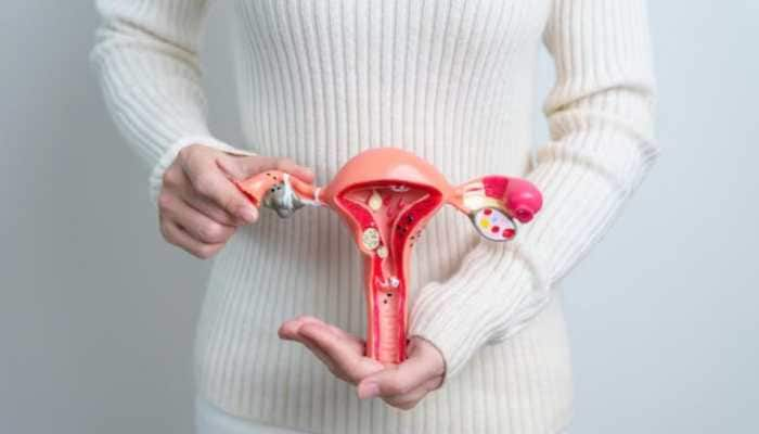 PCOD vs PCOS: Key Differences Every Woman Should Know - Expert Advice