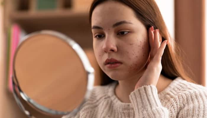 Acne In Your 20s? Know Why It Happens And How To Treat It