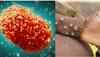Mpox Scare