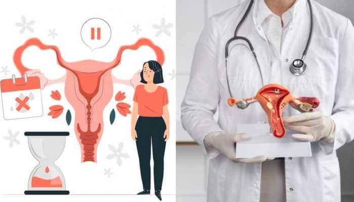 Doctor Explains The Link Between PCOS And Endometrial Cancer: Understanding The Risks