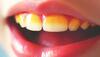 Yellow teeth