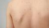 birthmarks