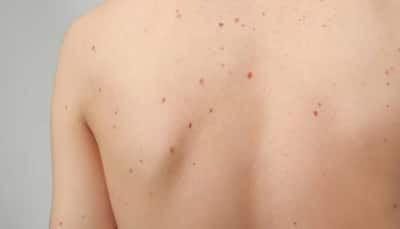 The Truth About Birthmarks: Separating Science From Superstition