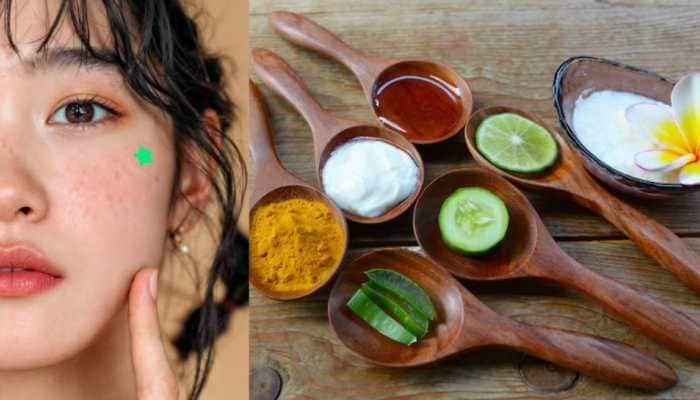 Natural Remedies For Acne: 10 DIY Face Packs For Glowing, Pimple-Free Skin